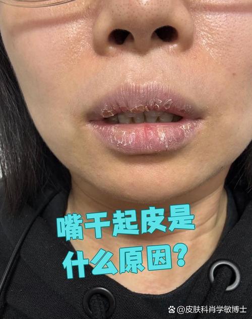 嘴唇起皮缺什么