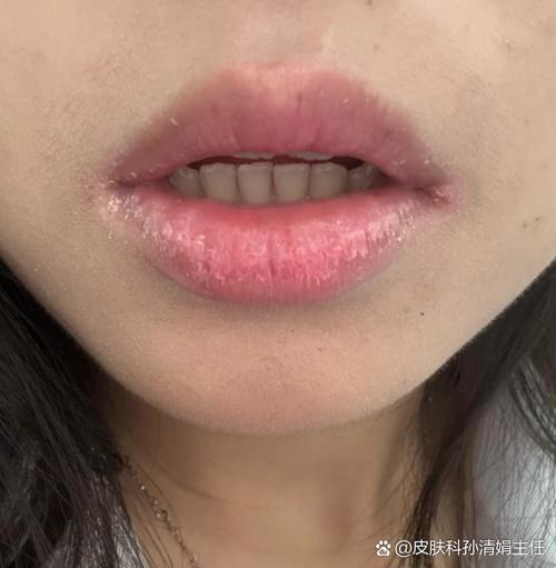 嘴唇起皮缺什么