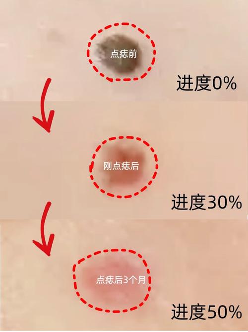 什么时候点痣好