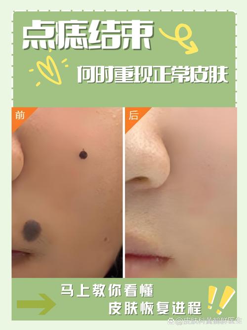 什么时候点痣好