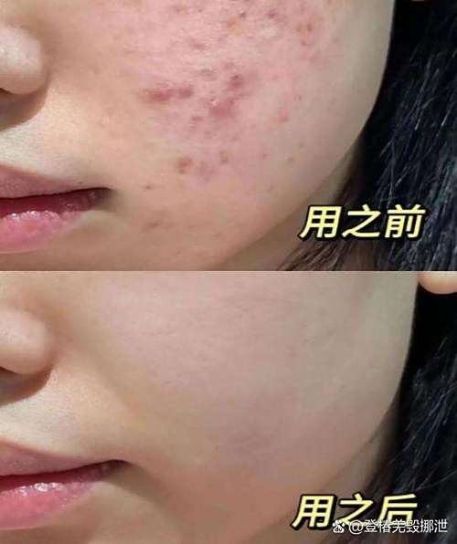 脸上长痘痘用洗面奶吗