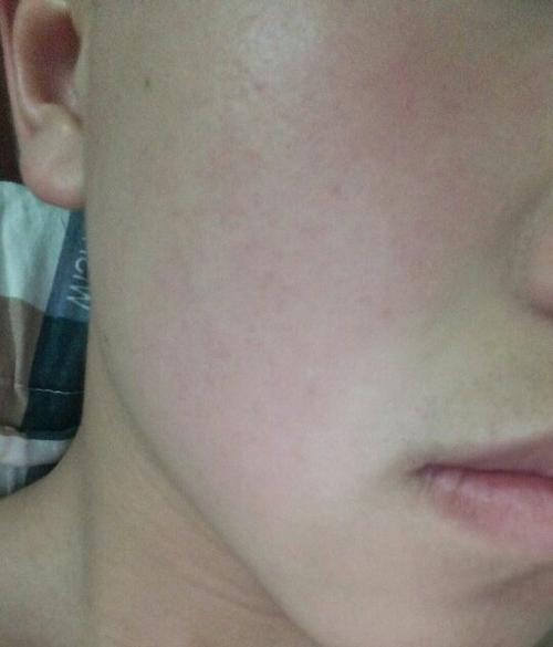 用洗面奶过敏了的图片