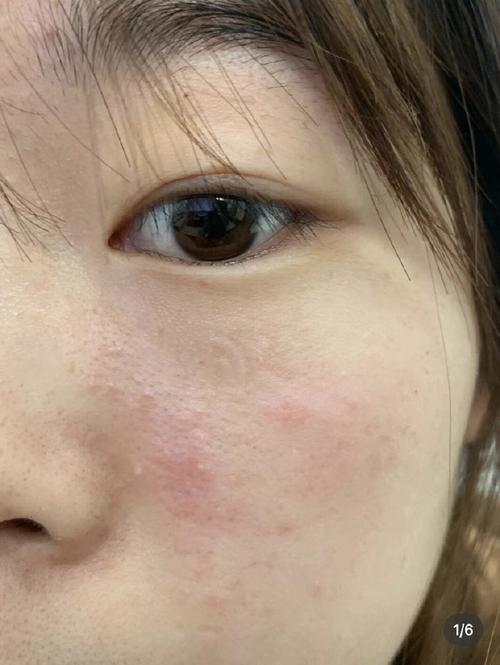 擦护肤品皮肤有刺痛感