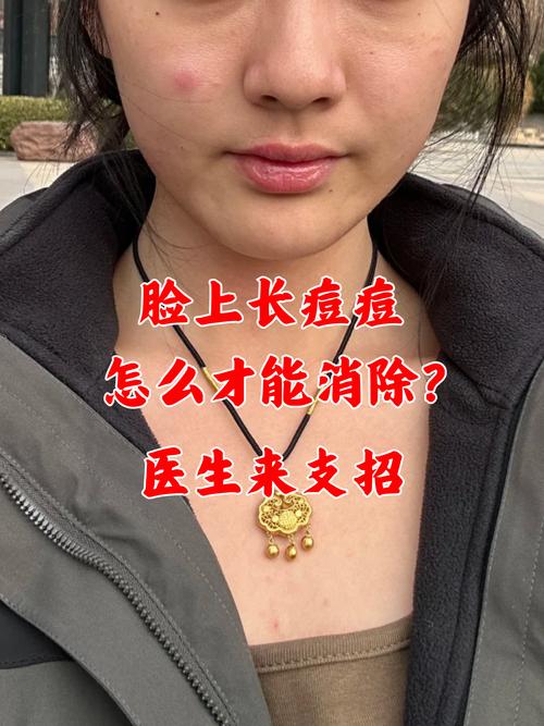 长痘痘是什么皮肤
