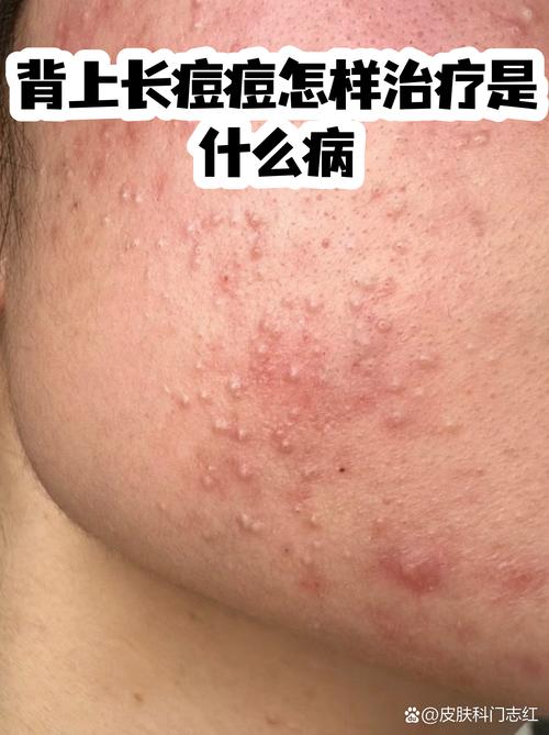 长痘痘是什么皮肤