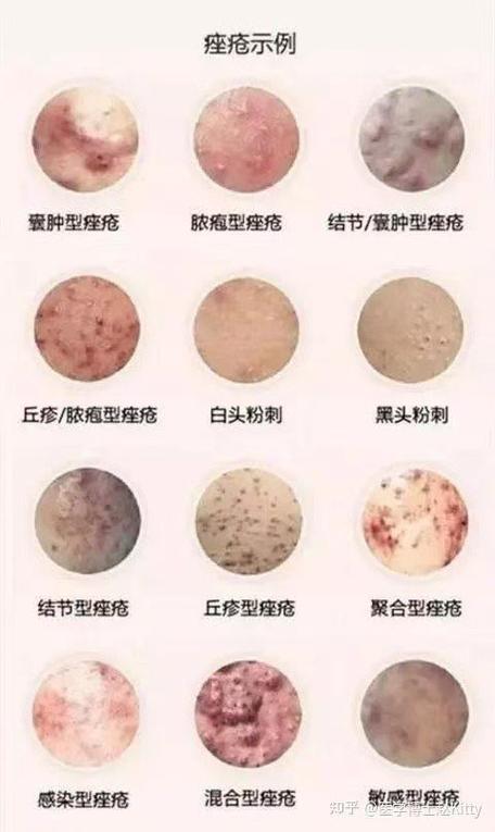 长痘痘是什么皮肤