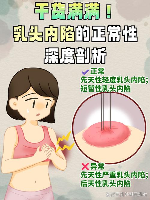 乳头内陷什么原因