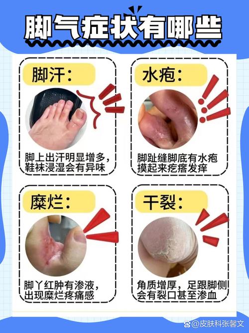 什么是足癣
