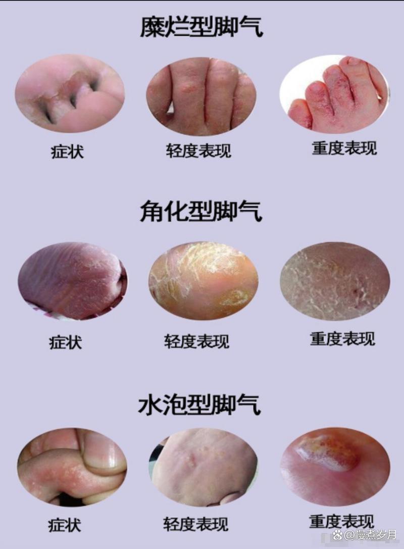 什么是足癣