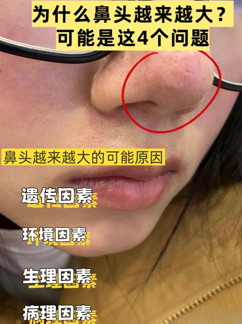 为什么鼻头大