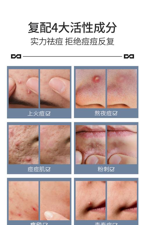 男士护肤品祛痘效果好