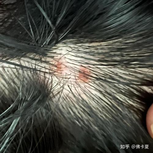 为什么头上长疙瘩