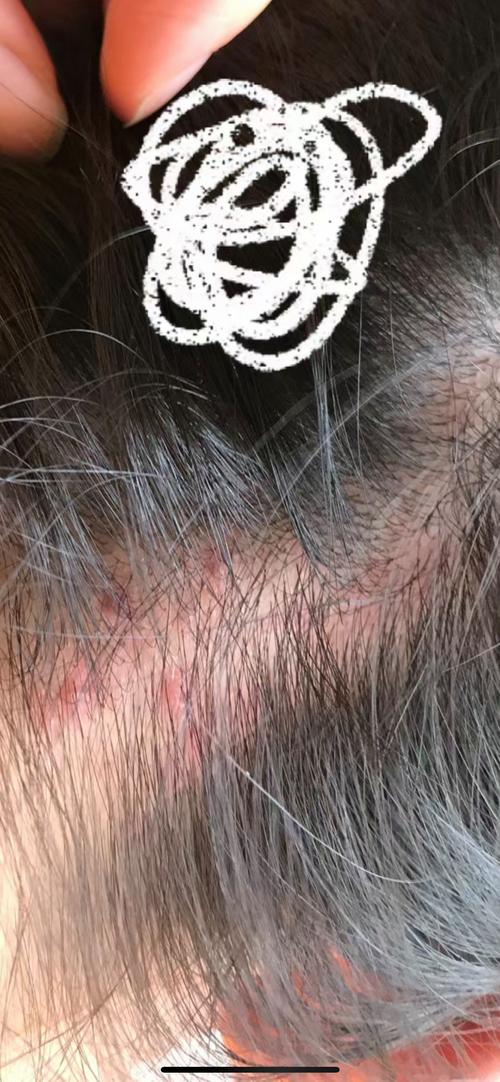 为什么头上长疙瘩