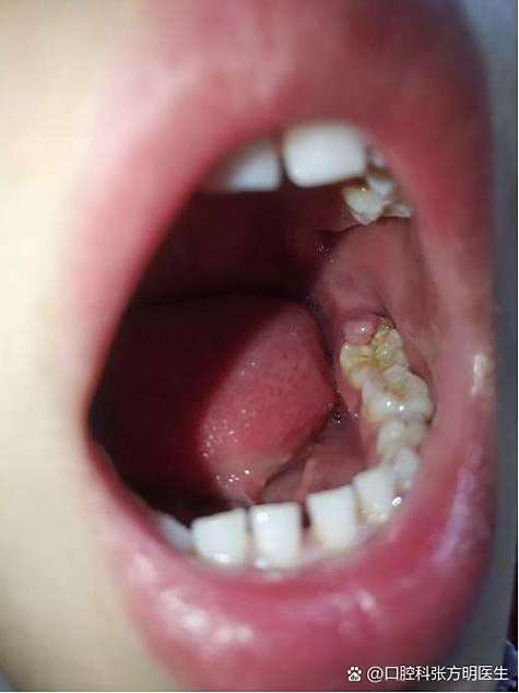 长智齿什么症状