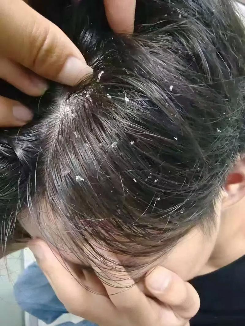 什么可以去头屑