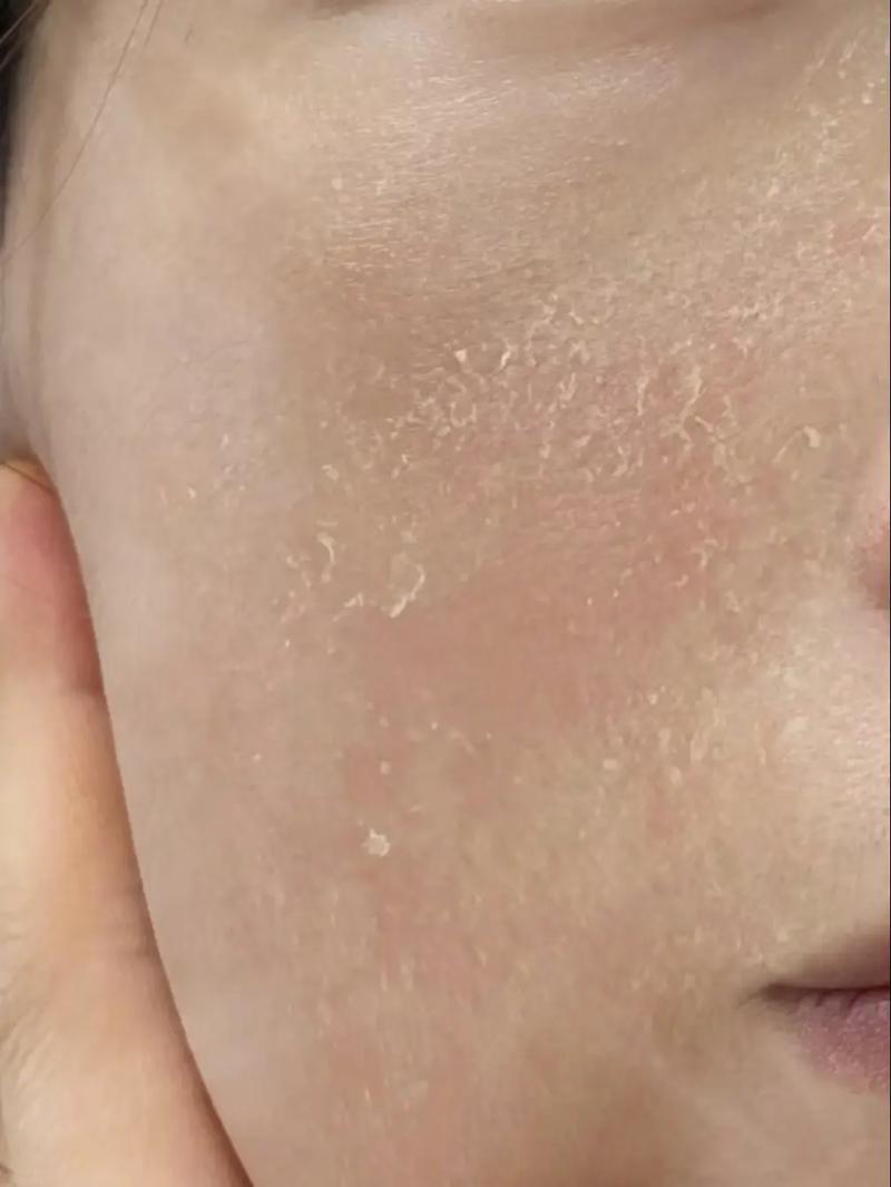 用洗面奶后脸干燥紧绷