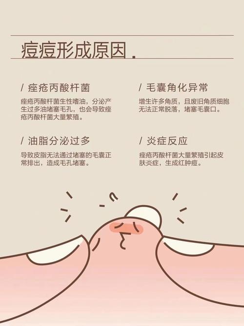 长痘痘的原因是什么