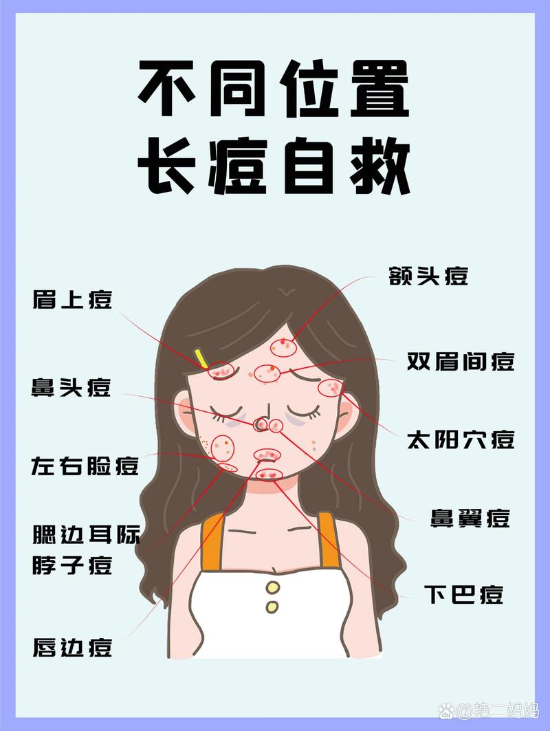 长痘痘的原因是什么