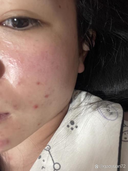 洗面奶洗的脸上起痘痘