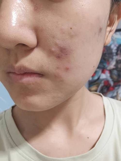 洗面奶洗的脸上起痘痘