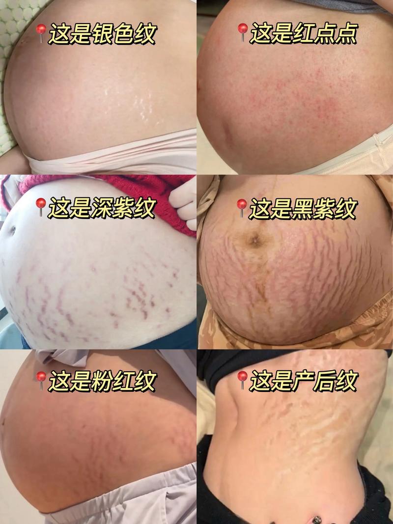 妊娠纹什么颜色