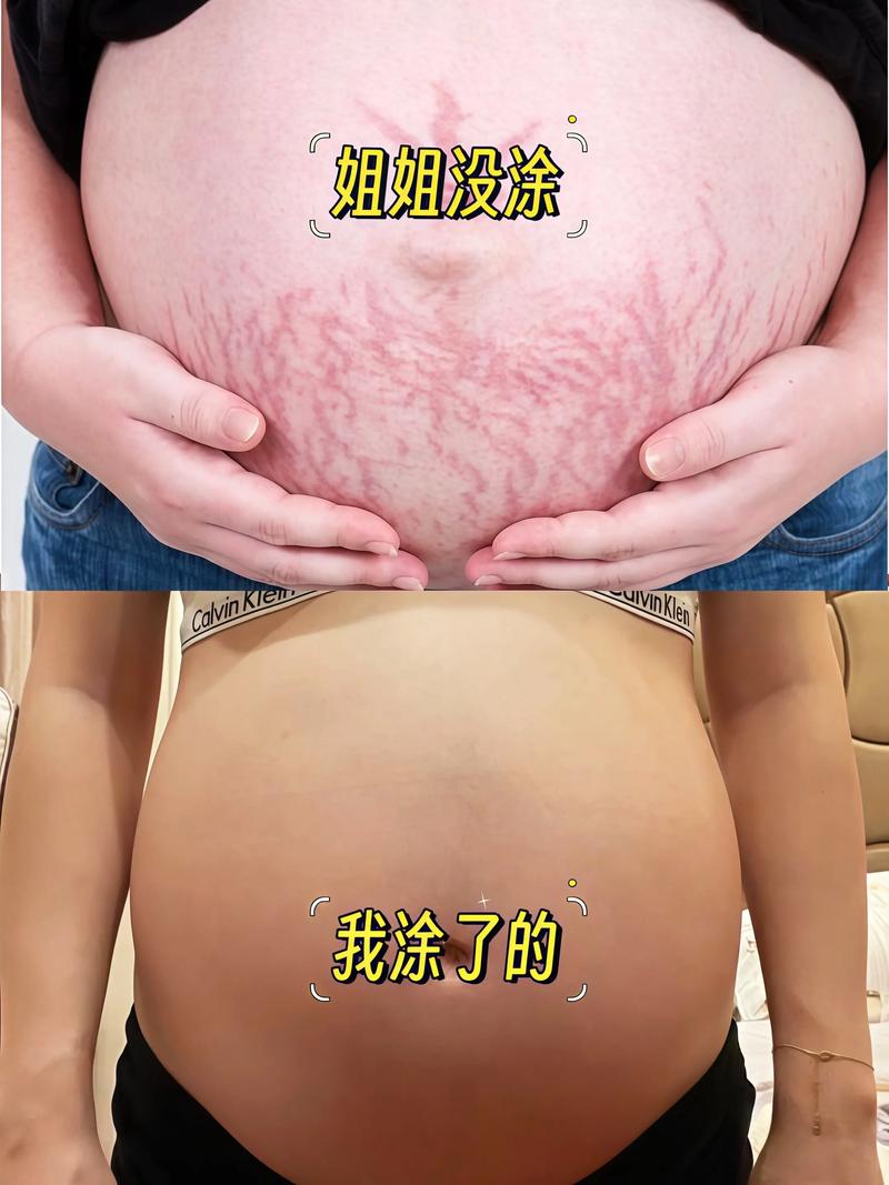 妊娠纹什么颜色