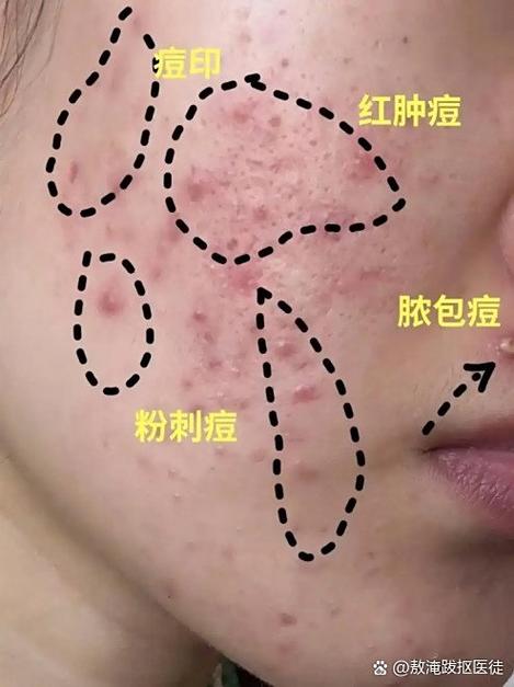 脸上长痘能用洗面奶吗