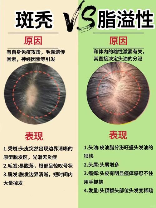 脱发什么原因引起的