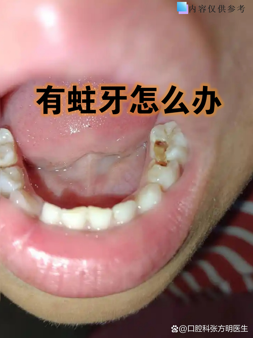 为什么会有虫牙