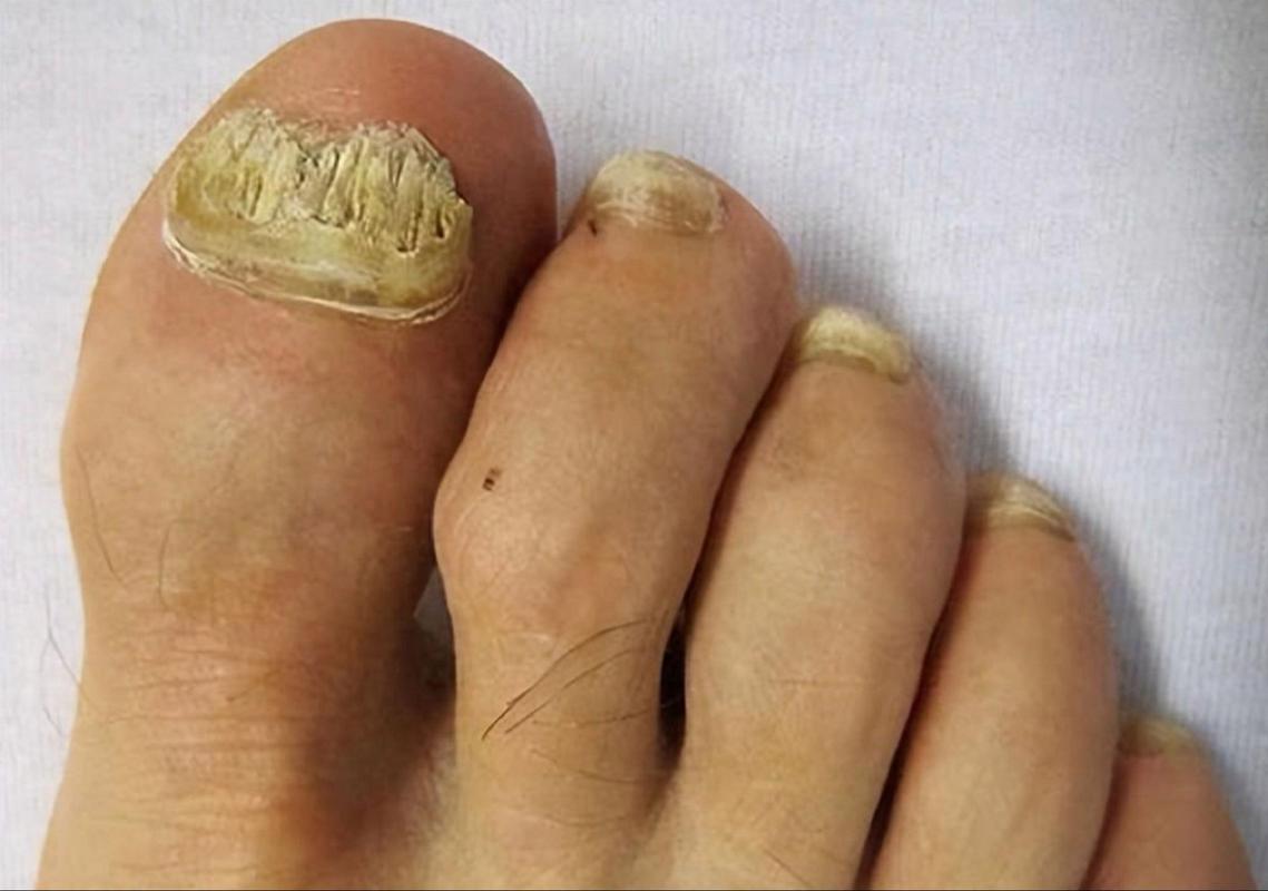 灰指甲是什么样