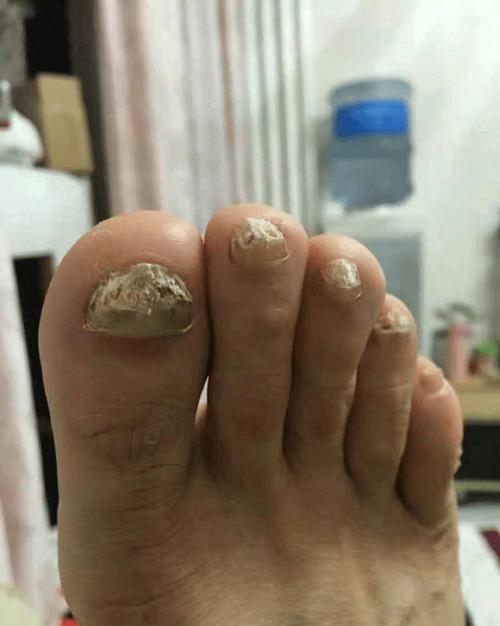 灰指甲是什么样