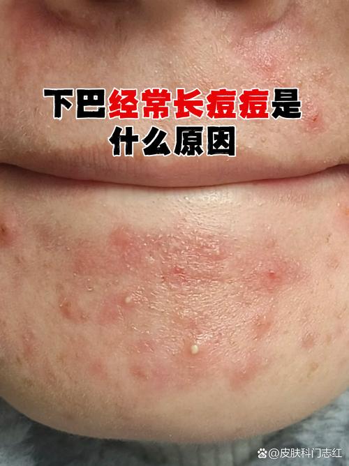 为什么下巴会长痘