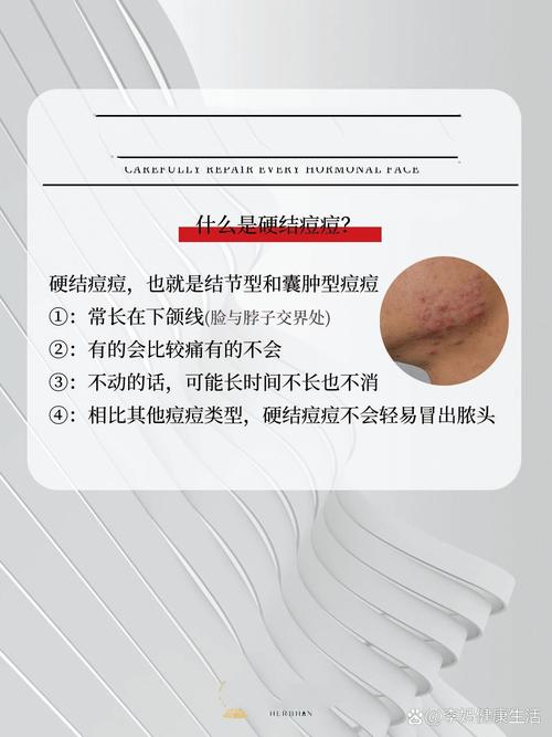 为什么下巴会长痘