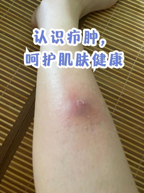 肿了是什么意思