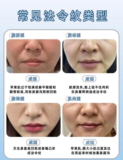 法令纹什么意思