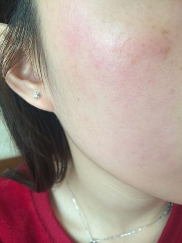 护肤品用着用着过敏了