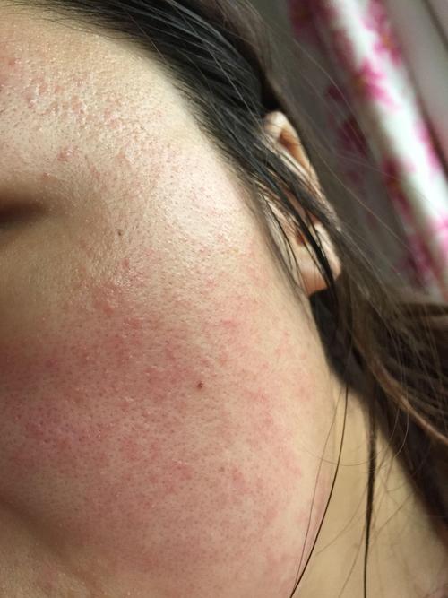 护肤品用着用着过敏了