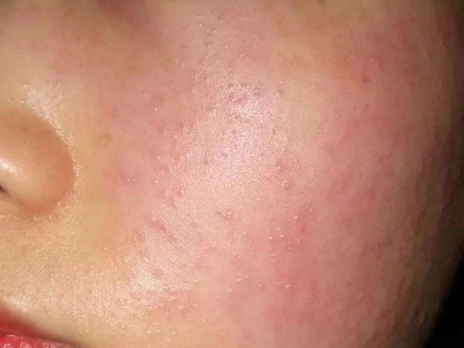 护肤品用着用着过敏了