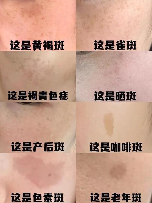 为什么长黄褐斑