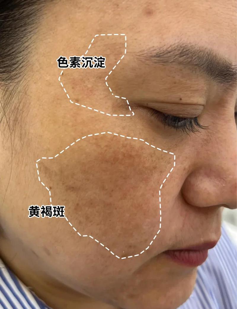 为什么长黄褐斑