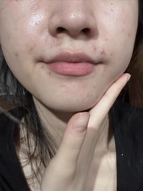 洗面奶洗完长痘痘了