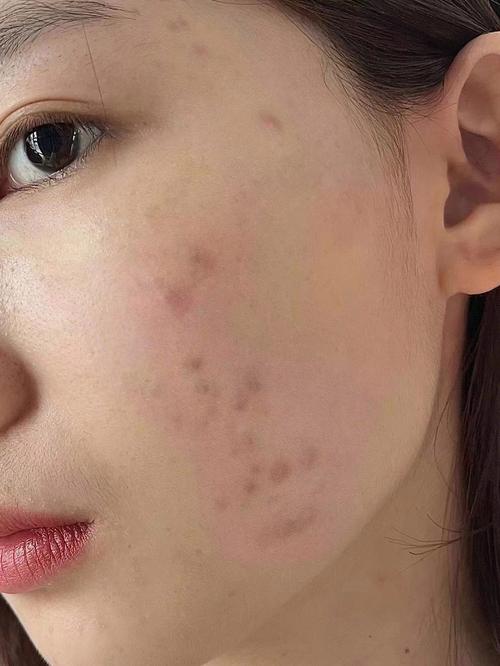 洗面奶洗完长痘痘了