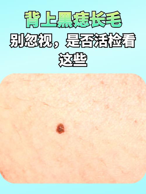 痣为什么会长毛