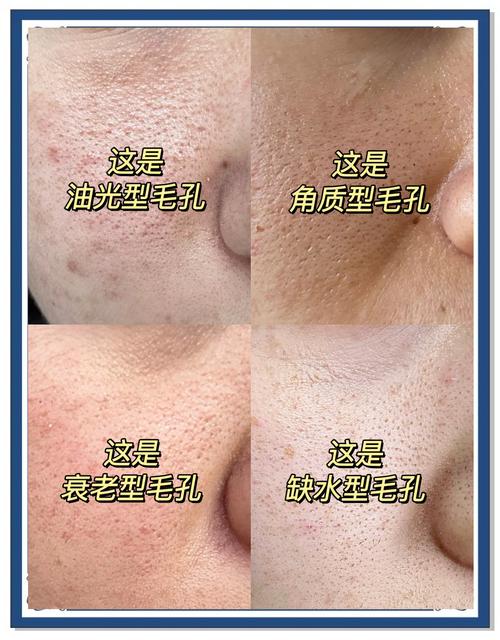 毛孔为什么会粗大