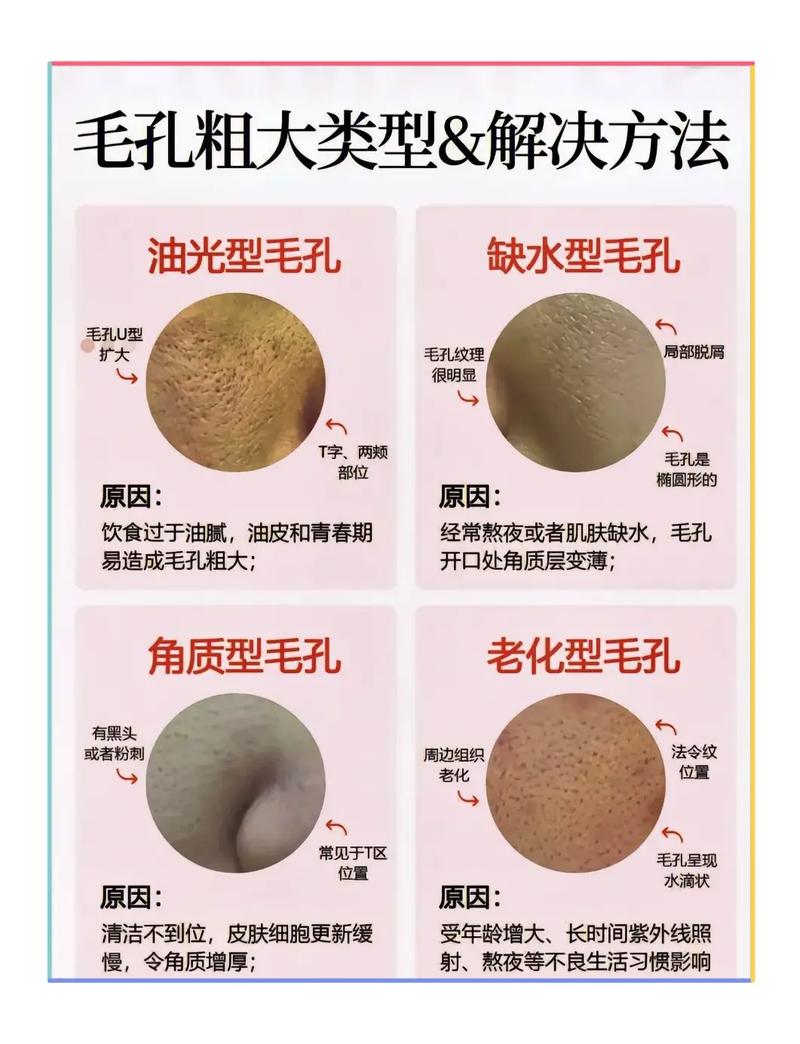 毛孔为什么会粗大