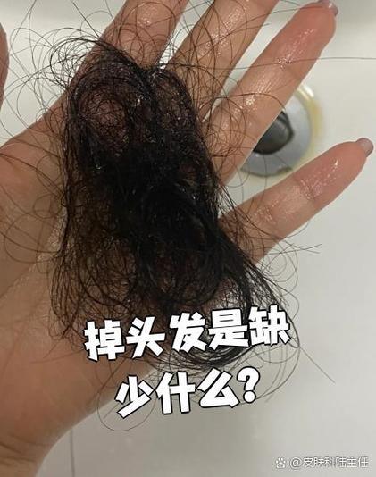 头发掉缺什么