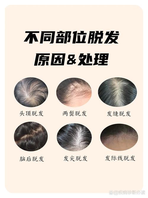 为什么会脱发严重