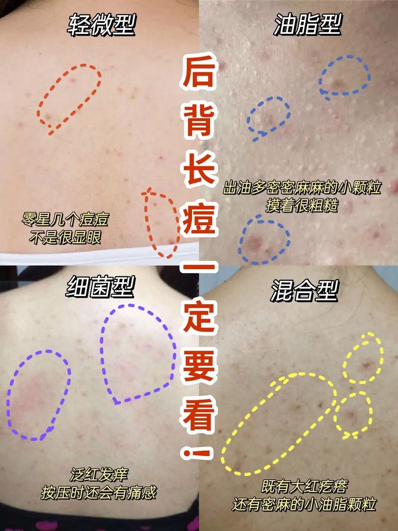 背上的痘痘是什么