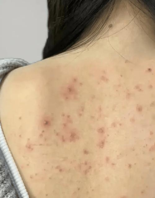 背上的痘痘是什么
