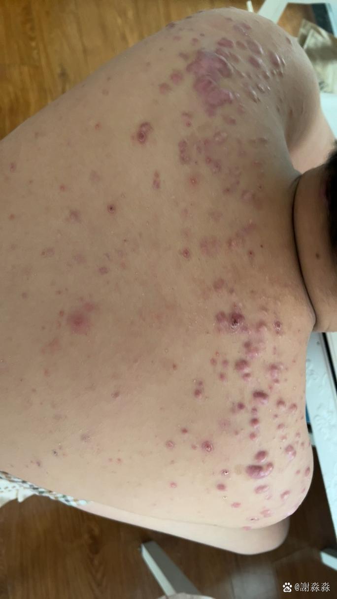 背上的痘痘是什么